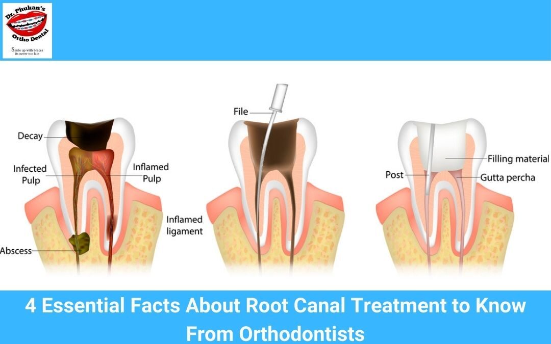 4 Essential Facts About Root Canal Treatment to Know From Orthodontists
