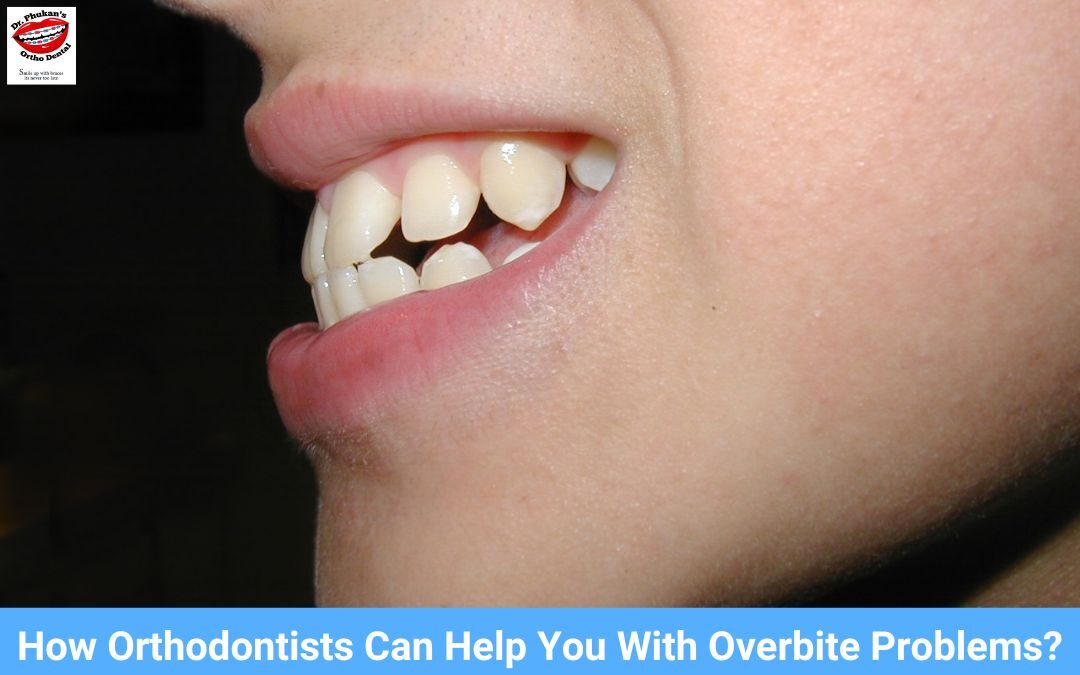 How Orthodontists Can Help You With Overbite Problems?