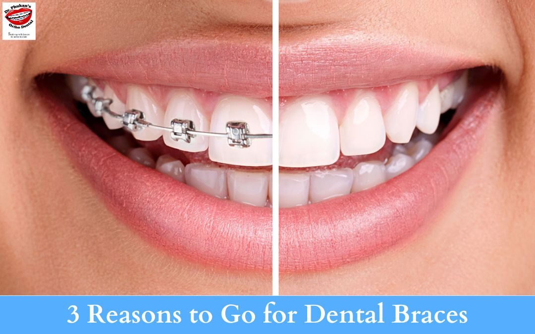 3 Reasons to Go for Dental Braces