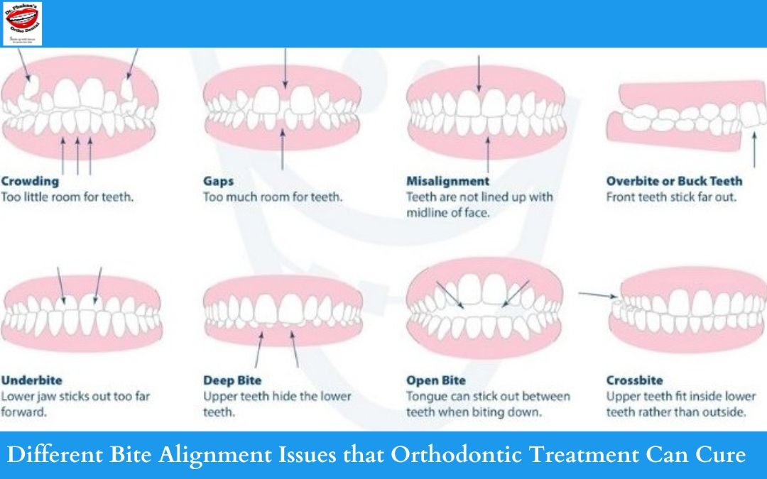 Different Bite Alignment Issues that Orthodontic Treatment Can Cure